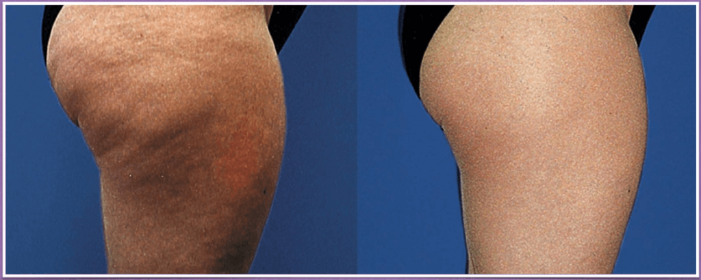 Wassereinlagerungen Beine loswerden vorher nachher Wassereinlagerungen Beine loswerden vorher nachher