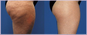 Anti Cellulite vorher-nachher Anti Cellulite vorher-nachher